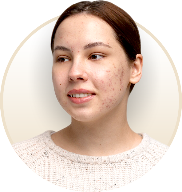 Acne Scarring